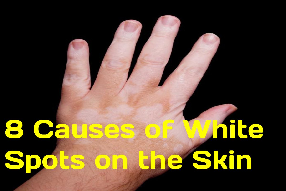 8 Causes Of White Spots On The Skin