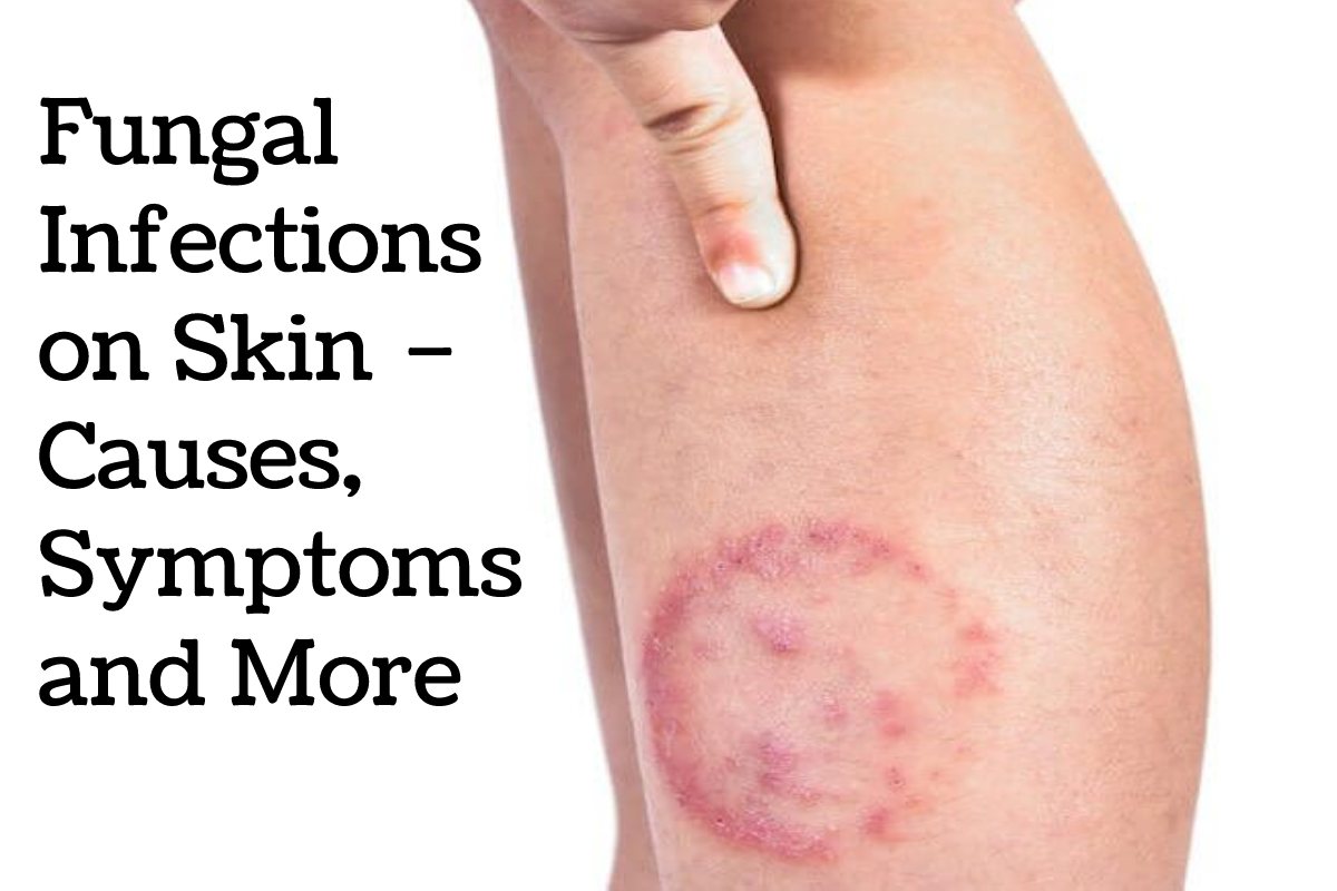 Fungal Infections on Skin – Causes, Symptoms and More